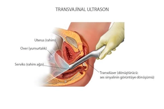 Koruyucu Sağlık Hizmetleri - alttan ultrason tvusg