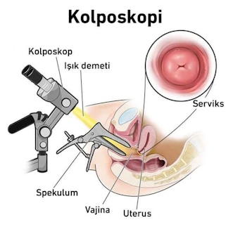 Koruyucu Sağlık Hizmetleri - kolposkopi