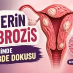 Uterin fibrozis - rahimde nebde dokusu